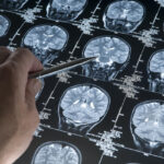 Glioblastoma in 15-39 year-olds: 230% increase in 20 years! – Article